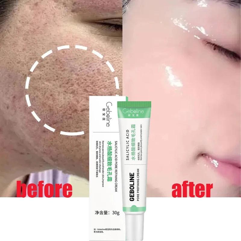 Salicylic Acid Pore Shrinking Cream