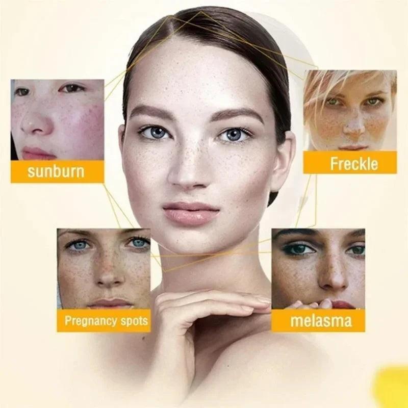 Freckle Cream for Dark Spots