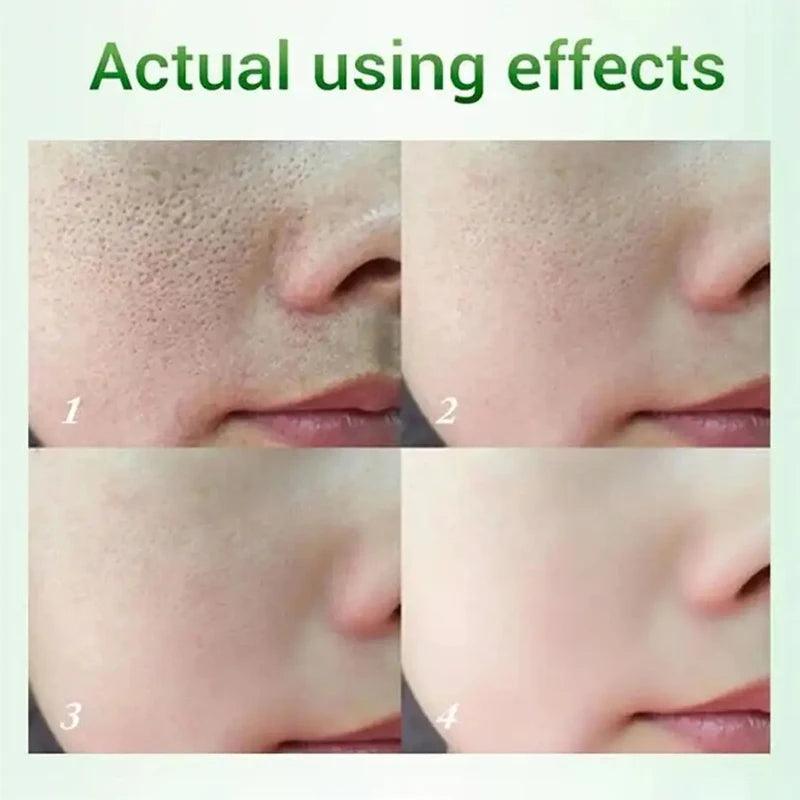 Salicylic Acid Pore Shrinking Cream