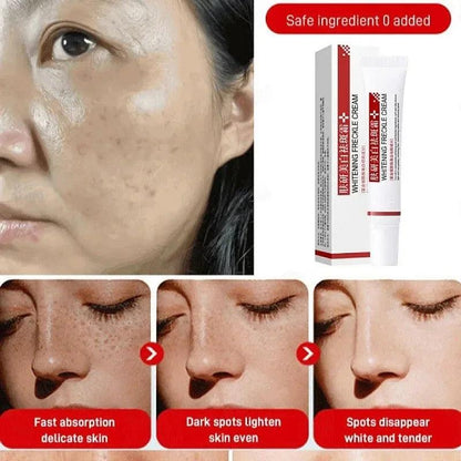 Freckle Cream for Dark Spots