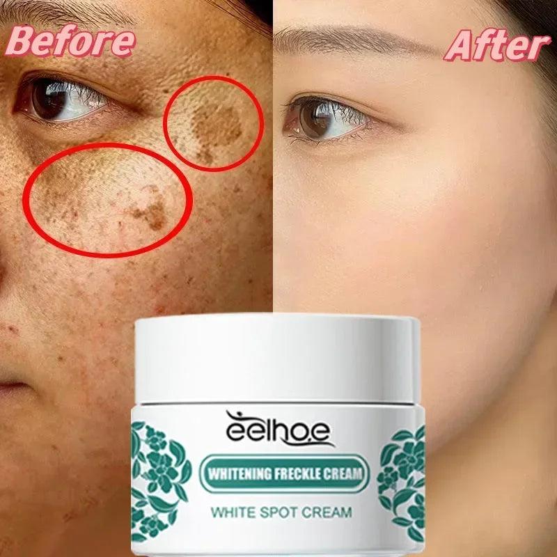 Melasma Brightening Cream