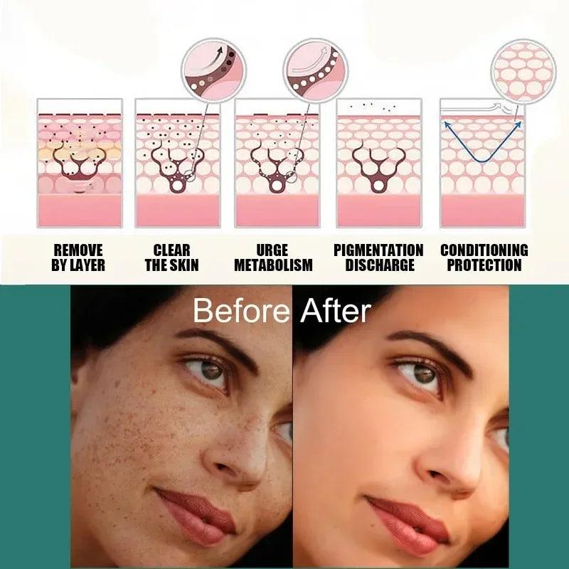 Melasma Brightening Cream